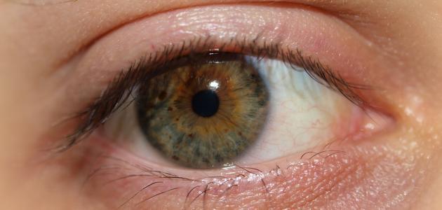 مرض جفاف العيون