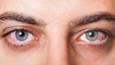 علاج جفاف العين الشديد